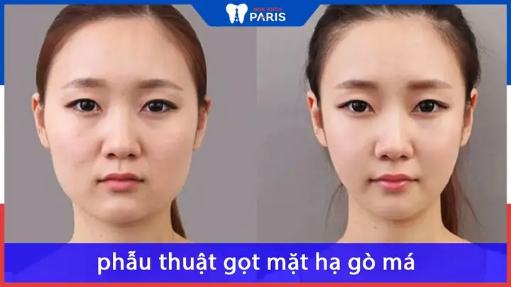 Tướng Số Khi Hạ Gò Má