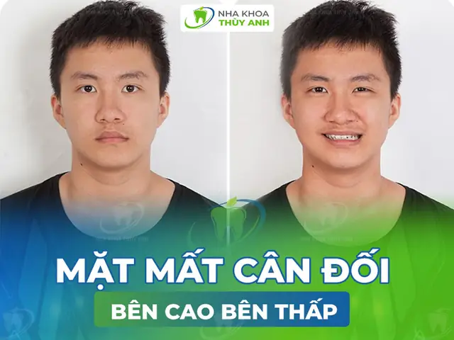 Tướng Số Miệng Méo Bên Trái Tướng Số Miệng Méo Bên Trái