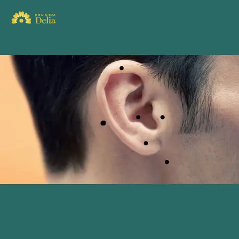 Tướng Số Mụn Ruồi Vành Tai Nam