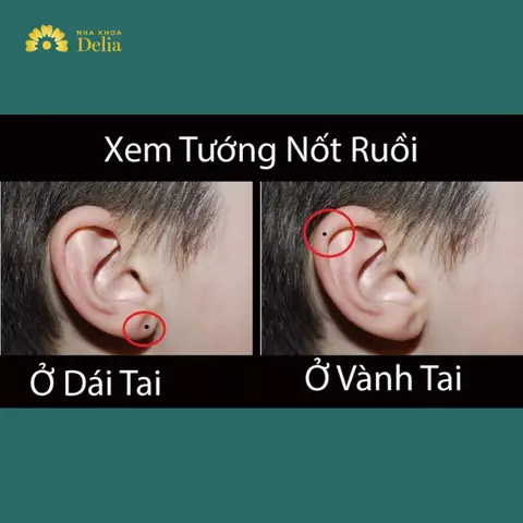 Tướng Số Mụn Ruồi Vành Tai Nam