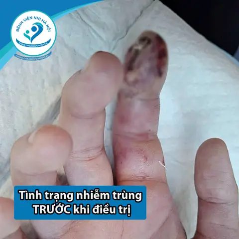 Tướng Số Ngón Tay To Ở Đầu