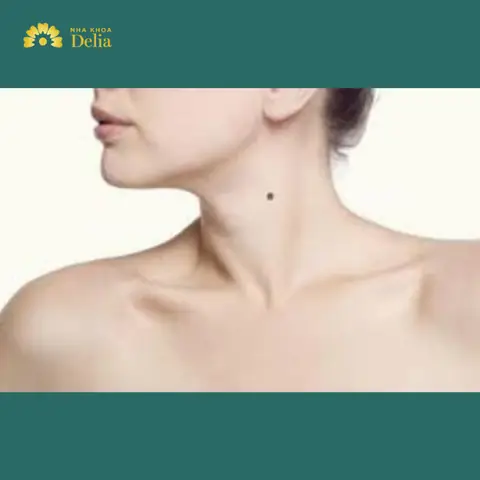 Tướng Số Nốt Ruồi Ở Cổ Tướng Số Nốt Ruồi Ở Cổ