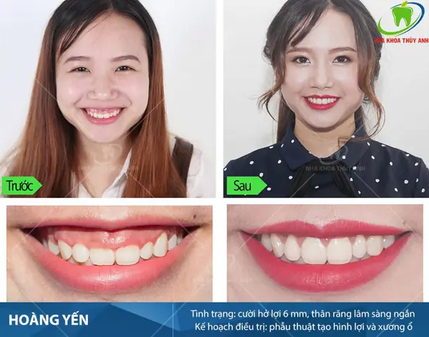 Tướng Số Phụ Nữ Cười Hở Lợi