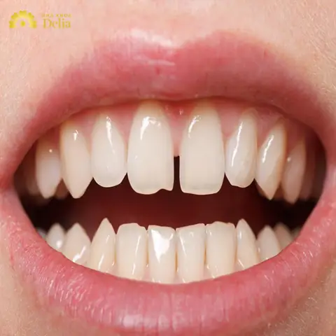 Tướng Số Răng Cửa Thưa Tướng Số Răng Cửa Thưa