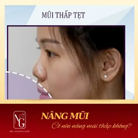 Tướng Số Sống Mũi Thấp Tướng Số Sống Mũi Thấp
