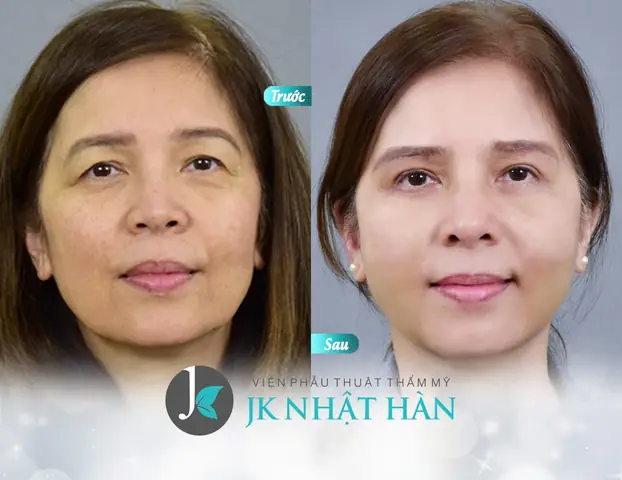 Xem Tướng Mắt Nhiều Mí Xem Tướng Mắt Nhiều Mí