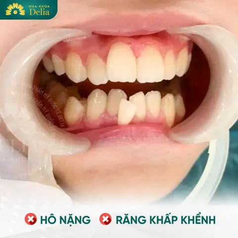 Xem Tướng Miệng Hô Xem Tướng Miệng Hô