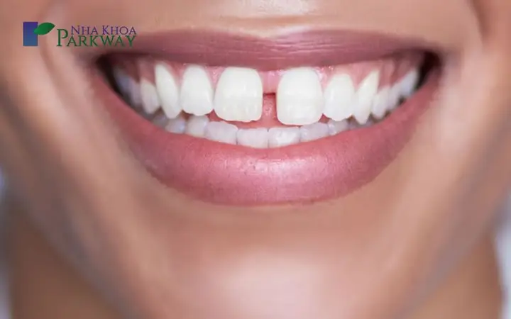 Xem Tướng Răng Cửa