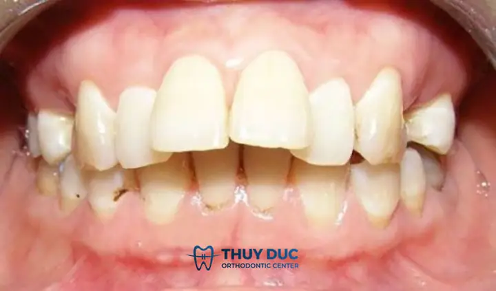 Xem Tướng Răng Hổ