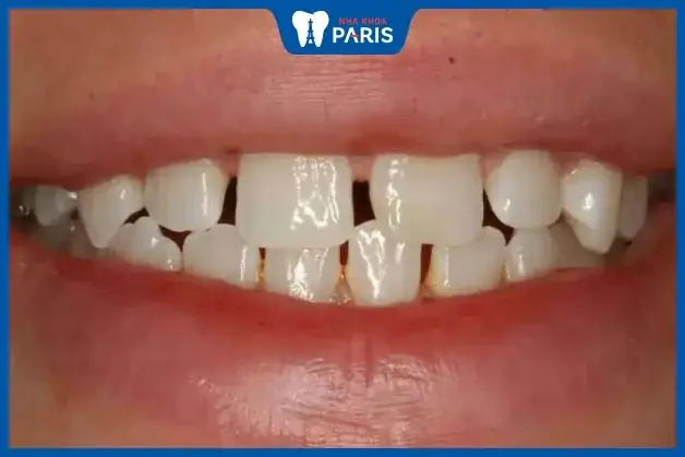 Xem Tướng Răng Phụ Nữ