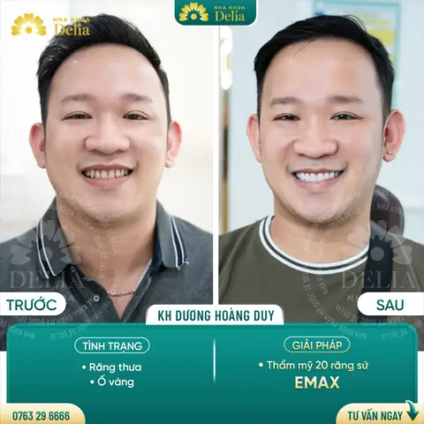 Xem Tướng Răng Thưa