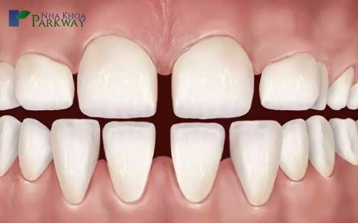 Xem Tướng Răng Thưa Hàm Dưới
