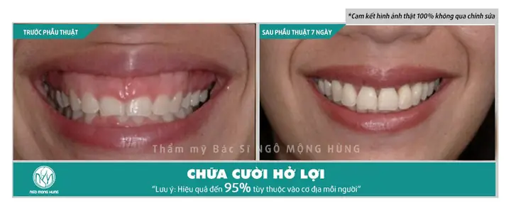 Xem Tướng Số Cười Hở Lợi