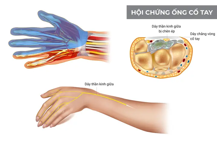 Bị Đứt Tay Ngón Trợ La Điềm Gì