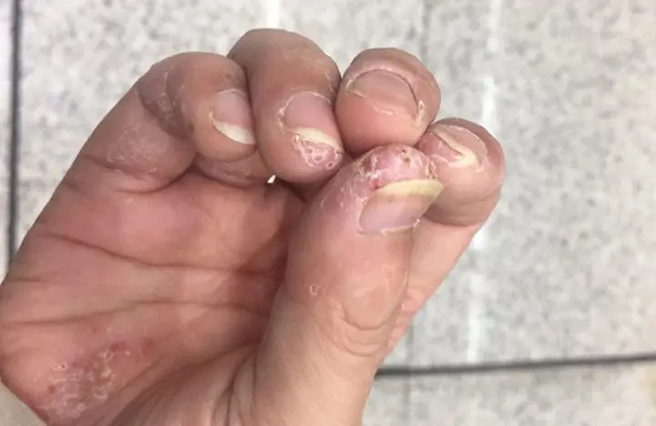 Bị Đứt Tay Ngón Trợ La Điềm Gì