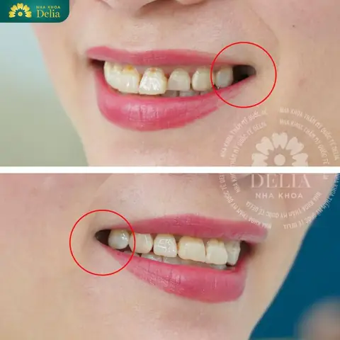 Bị Gãy Răng Cửa Là Điềm Gì