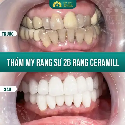 Bị Gãy Răng Cửa Là Điềm Gì