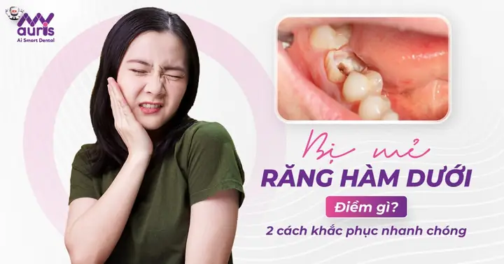 Bị Mẻ Răng Hàm Dưới Điềm Gì