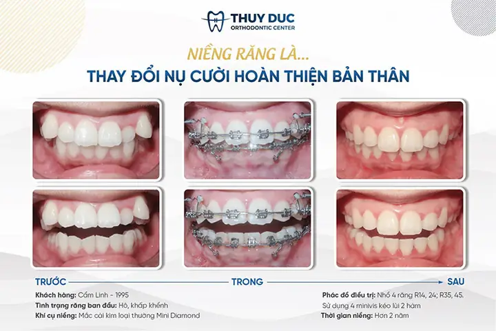 Các Tướng Răng