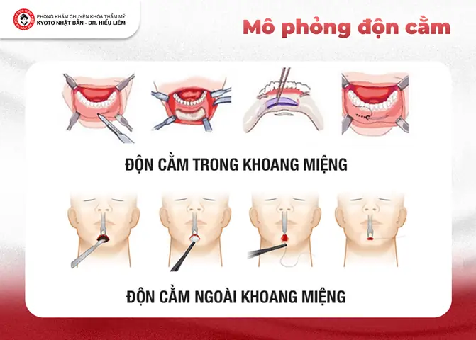 Cằm Lẹm Tướng Số Cằm Lẹm Tướng Số