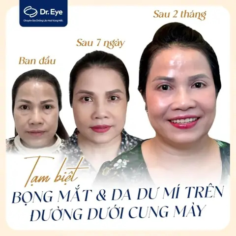 Cắt Mí Mắt Có Ảnh Hưởng Đến Tướng Số Không