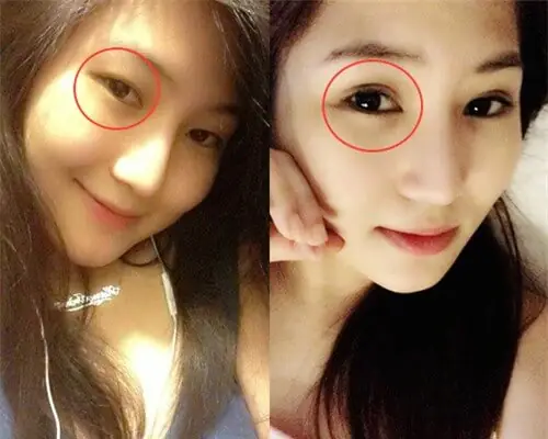 Cắt Mí Mắt Có Ảnh Hưởng Đến Tướng Số Không