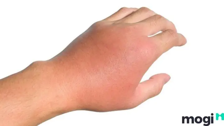 Đầu Năm Bị Ong Đốt La Điềm Gì Đầu Năm Bị Ong Đốt La Điềm Gì