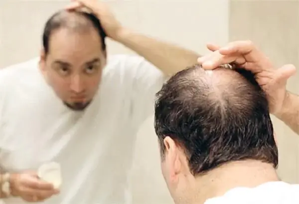Điềm Báo Giấc Mơ Thấy Tóc Rụng