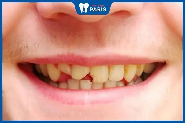 Giải Mã Giấc Mơ Bị Mẻ Răng Giải Mã Giấc Mơ Bị Mẻ Răng