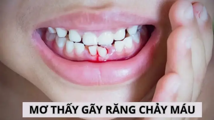 Giải Mã Giấc Mơ Chảy Máu Răng