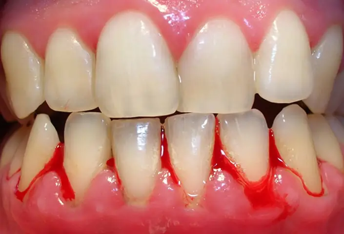 Giải Mã Giấc Mơ Chảy Máu Răng Giải Mã Giấc Mơ Chảy Máu Răng