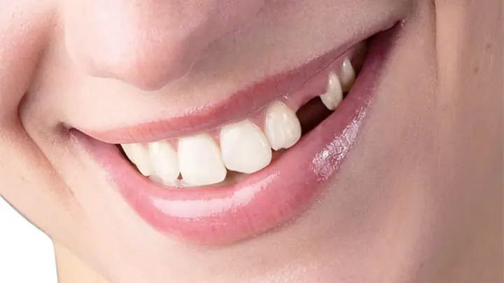Giải Mã Giấc Mơ Rụng Răng Đánh Con Gì