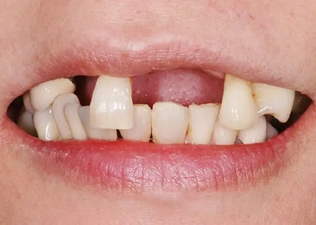 Giải Mã Giấc Mơ Rụng Răng Hàm Trên
