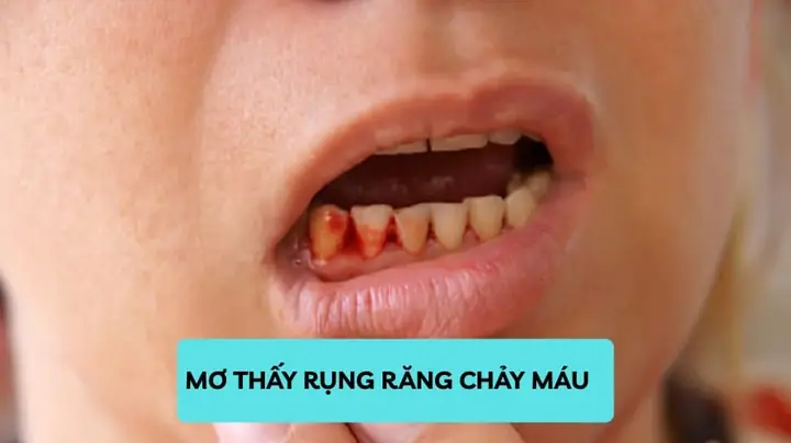 Giải Mã Giấc Mơ Thấy Gãy Răng Chảy Máu