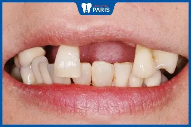 Giải Mã Giấc Mơ Thấy Rụng Nhiều Răng