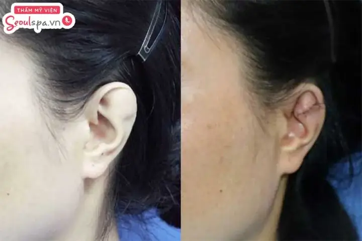 Hình Ảnh Tướng Tai Chuột