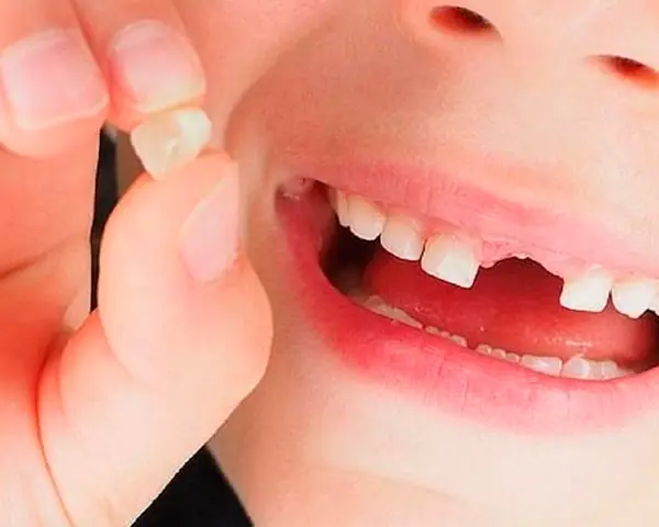 Mơ Bị Gãy Răng Cửa Là Điềm Báo Gì Mơ Bị Gãy Răng Cửa Là Điềm Báo Gì
