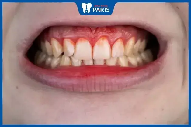Mơ Thấy Chảy Máu Răng Đánh Con Gì Mơ Thấy Chảy Máu Răng Đánh Con Gì