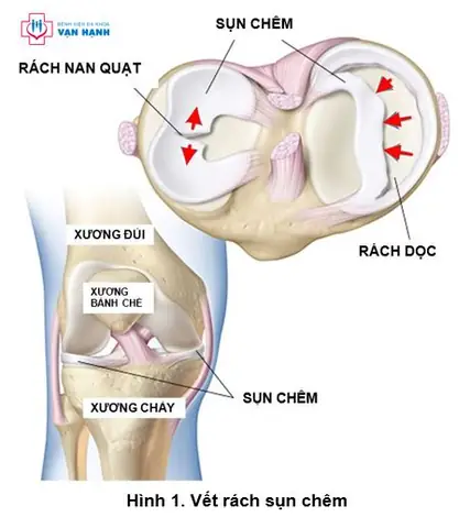 Mơ Thấy Người Khác Bị Chém Đứt Đầu