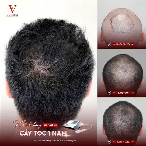 Nằm Mơ Bị Hói Đầu Đánh Con Gì