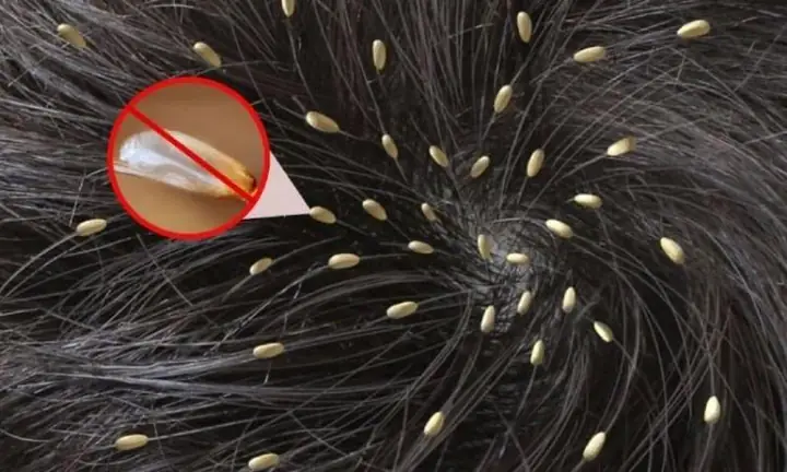 Nằm Mơ Thấy Chấy Trên Đầu Người Khác
