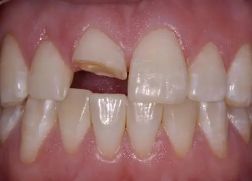 Nằm Mơ Thấy Gãy Răng Cửa Chảy Máu