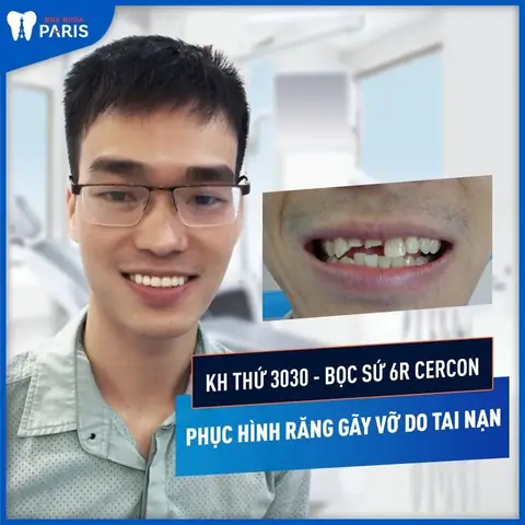Nằm Mơ Thấy Gãy Răng Cửa Đánh Đề Con Gì Nằm Mơ Thấy Gãy Răng Cửa Đánh Đề Con Gì