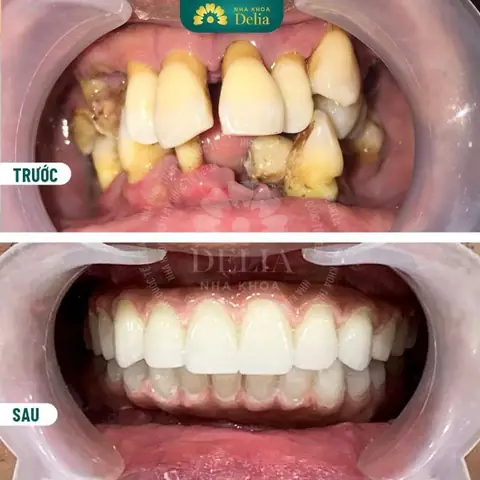 Nằm Mơ Thấy Gãy Răng Cửa Không Chảy Máu