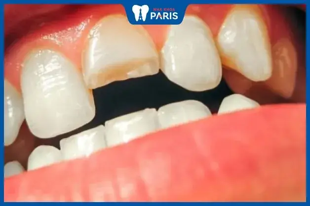Nằm Mơ Thấy Mẻ Răng Đánh Con Gì Nằm Mơ Thấy Mẻ Răng Đánh Con Gì