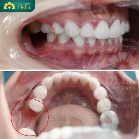 Nằm Mơ Thấy Mẻ Răng Không Chảy Máu Nằm Mơ Thấy Mẻ Răng Không Chảy Máu