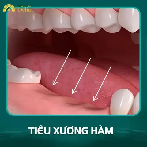Nằm Mơ Thấy Mẻ Răng Không Chảy Máu Nằm Mơ Thấy Mẻ Răng Không Chảy Máu