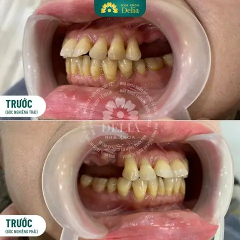 Nằm Mơ Thấy Mẻ Răng Không Chảy Máu Nằm Mơ Thấy Mẻ Răng Không Chảy Máu