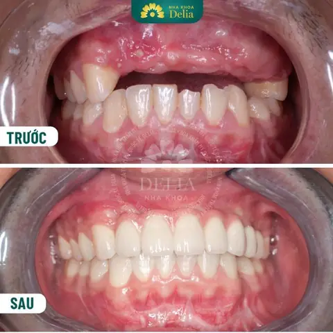 Nằm Mơ Thấy Mẻ Răng Không Chảy Máu