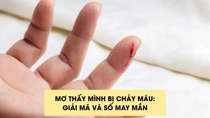 Nằm Mơ Thấy Mình Bị Chảy Máu Tay